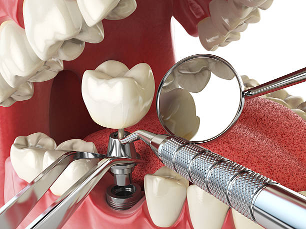 Best Emergency Treatment for Dental Infections or Abscesses in Nashville, MI